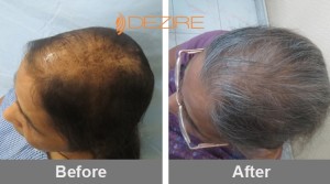 Androgenic Alopecia In Pune jayshree andhare 600 fue2-min