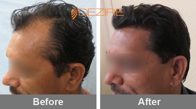 Average Cost Of Hair Transplant Surgery In Pune balraj shirale 2500  fue2-min – Hair Transplant Pune