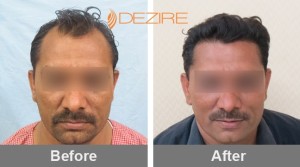 Best Hair Restoration Method In Pune balraj shirale 2500 fue-min