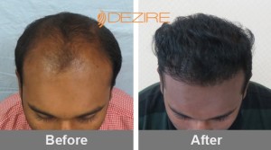 Best Hair Transplant Results In Pune nimish thorat 4000 fue2-min