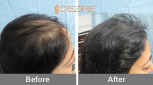 Excessive Hair Loss In Pune kalyani joshi 1500 fue2-min