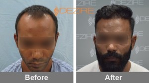 Hair Operation In Pune nitin kumbhar 3000 fue-min