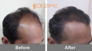 Hair Plantation Surgery In Pune dr latkar 2000 fue2-min