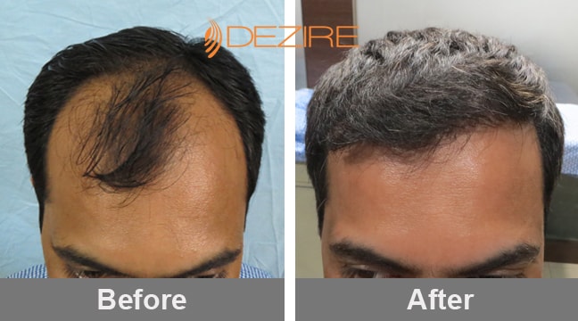 Best Hair Transplant Clinic in Pune for Natural & Permanent Hair Restoration  | Dezire Clinic Pune