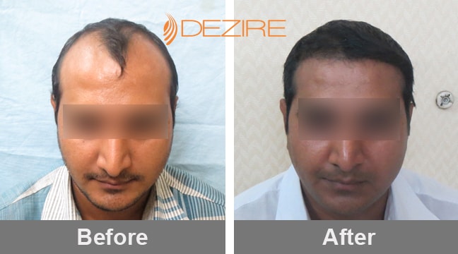 Non Surgical Hair Transplant In Pune chandrakant shewale 3000 fue-min – Hair  Transplant Pune