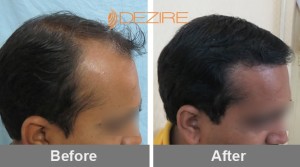 Receding Hairline In Pune 2ajay chauhan 3000 fue-min