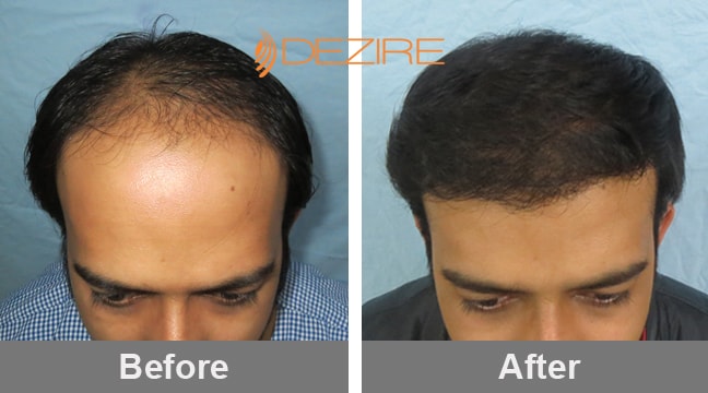 Receding Hairline Treatment In Pune omkar 3000 fue2-min – Hair Transplant  Pune