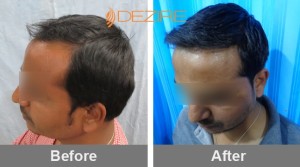 Womens Hair Transplant Cost In Pune channabasappa 1800 fue2-min
