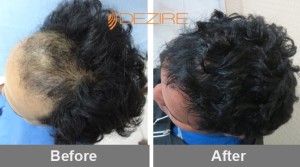 alopecia areata treatment in pune chetan kamthe 2000 fue2
