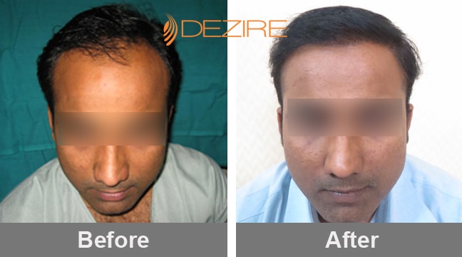 Best Hair Transplant Clinic in Pune for Natural & Permanent Hair  Restoration | Dezire Clinic Pune