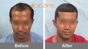 hair transplant regrowth in pune cameron gomes 2000 fue-min