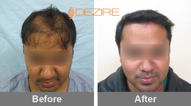 Best Hair Transplant Clinic in Pune for Natural ...