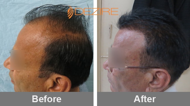 natural hair growth in pune dattaray khairnar 2200 fue2-min – Hair  Transplant Pune