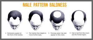 male_bald