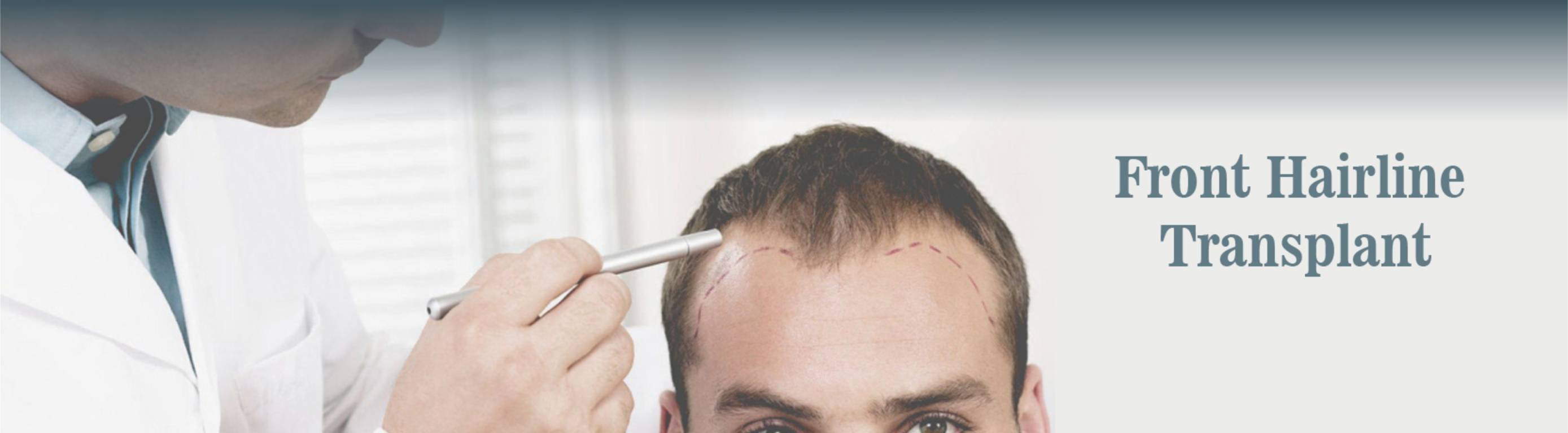 HAIR TRANSPLANT AND RESTORATION DONE AT DEZIRE CLINIC
