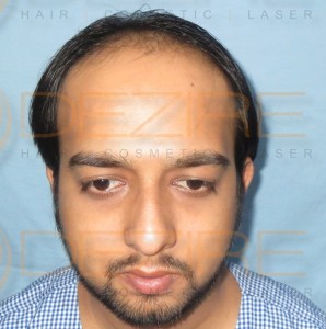 Real Hair Transplant Results