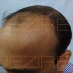 best hair Restoration surgery procedure in india
