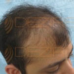 cheapest hair transplant cost in india