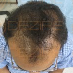 disadvantages of hair transplant in hindi