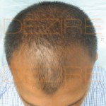 famous hair transplant surgeons in india