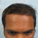 fue hair transplant recovery timeline