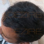 fue hair transplant results after 3 months