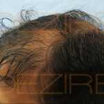 hair follicle transplant before and after