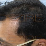 hair replacement in pune