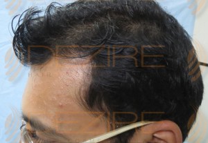 hair replacement in pune
