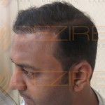 hair transplant before and after 5000 grafts