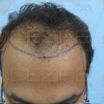 hair transplant ke side effect