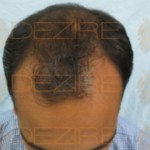 hair transplant pictures day by day