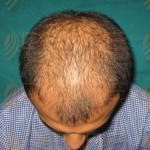 hair transplant side effectshair transplant side effects
