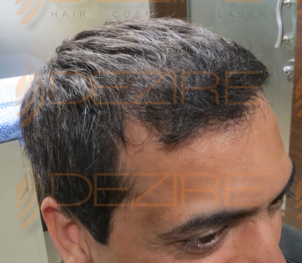 Hair Transplant Near Me done at Dezire Clinic Pune | Hair ...