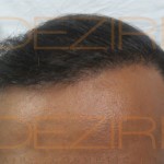 hair transplant surgery how much cost