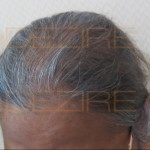 is female pattern baldness reversible