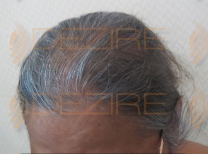 is female pattern baldness reversible