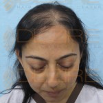 natural female hair loss treatment