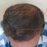 non surgical hair replacement cost in Pune