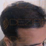 post hair transplant care fue