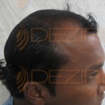 prp for hair loss cost