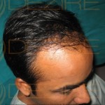 regrow hair naturally on bald head