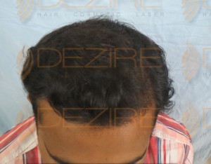 what to expect after hair restoration